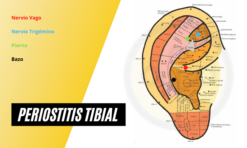 Periostitis Tibial Auriculoterapia.png